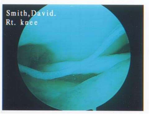 knee3