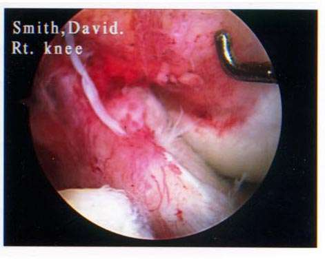 a torn meniscus